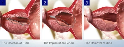 Исследование показало, что лечение аденомы простаты с iTind действует более четырех лет