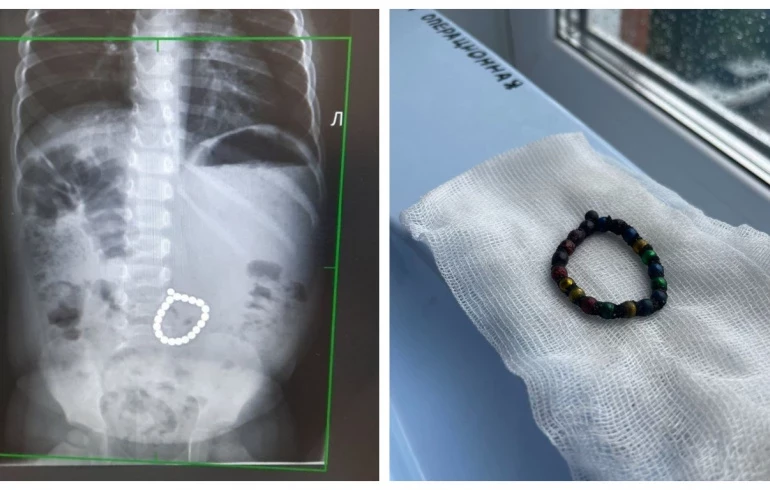 В Миассе хирурги спасли жизнь двухлетнего малыша, проглотившего 20 магнитов