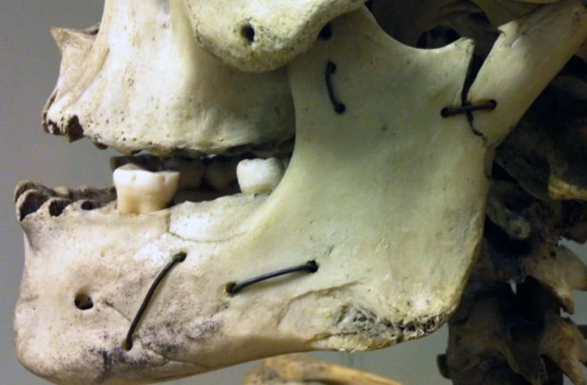 Французские палеонтологи впервые описали травмы посаженного на кол человека