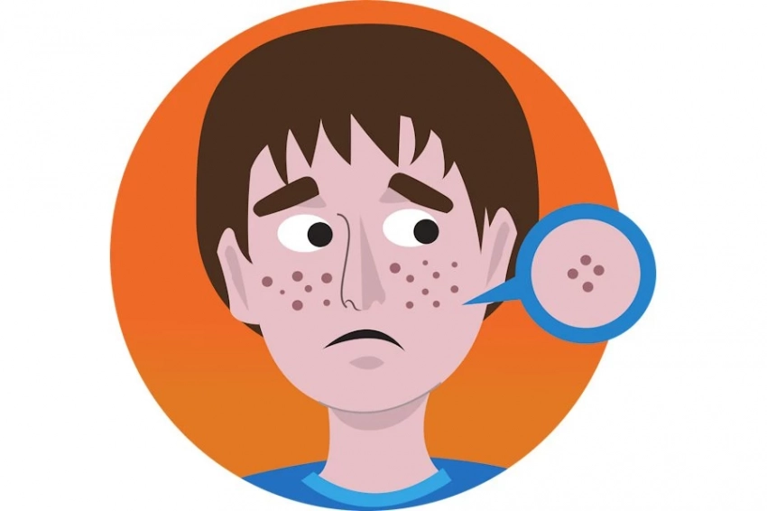 Ученые выявили, что витамин D и чай способны уберечь от прыщей