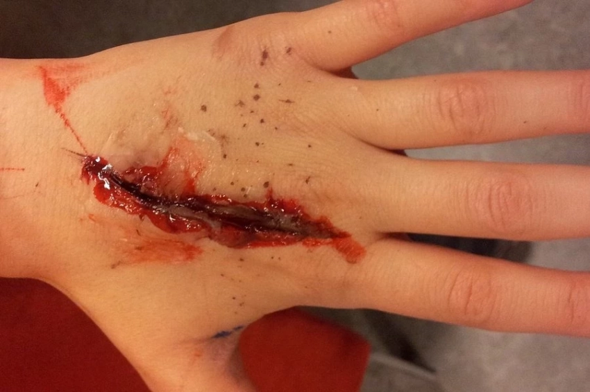 Лазерная кавитация против ран и опухолей: новая методика российских ученых